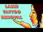 Laser Tattoo Removal Hoboken NJ Tattoo Removal