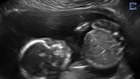 Baby Punches Own Head In Ultrasound