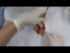 Re-upload - Derm surgery: excision of basal cell carcinoma