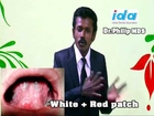 DR PHILIP MDS-IDA......The 5 MAGIC Words to Oral Cancer (Oral Squamous Cell Carcinoma Diagnosis