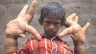 Mystery Condition Gives Indian Boy Gigantic Hands