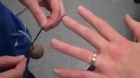 A good method to remove a ring from a swollen finger