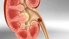 How Do Kidney Stones Form?  How Can We Prevent Them
