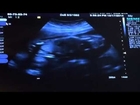 20 week pregnancy anatomy scan baby girl